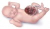 Thoát vị qua dây rốn ở trẻ em ( Omphalocele )