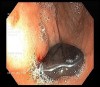 Dị vật tiêu hóa ở trẻ em