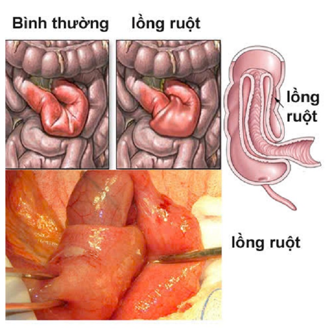 LỒNG RUỘT Ở TRẺ EM  ĐIỀU TRỊ NHƯ THẾ NÀO?