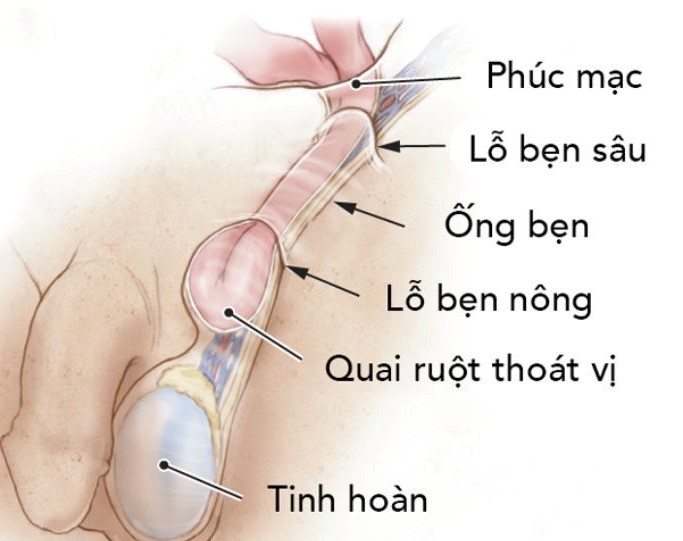 BỆNH LÝ THOÁT VỊ BẸN Ở TRẺ EM LÀ GÌ