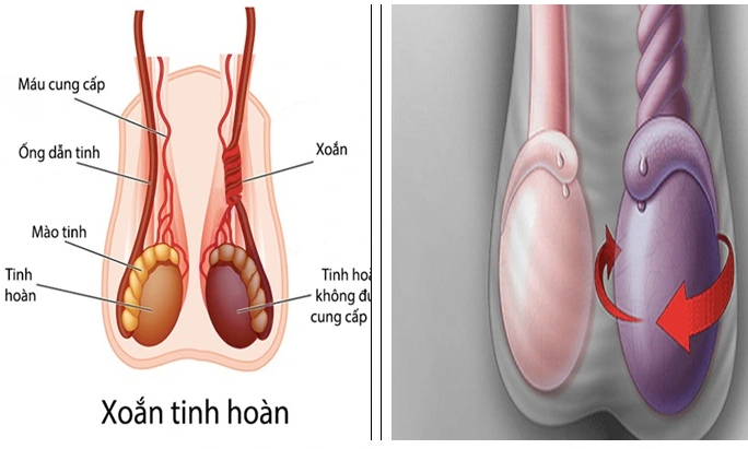 TÌM HIỂU VỀ XOẮN TINH HOÀN TRẺ EM