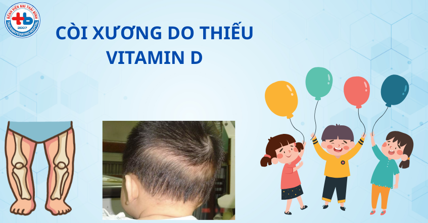 Còi xương do thiếu Vitamin D ở trẻ em